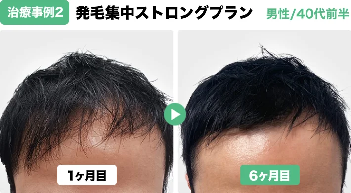 治療事例2：発毛集中ストロングプラン【男性/40代前半】